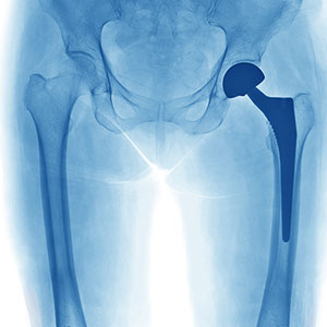 Joint replacement