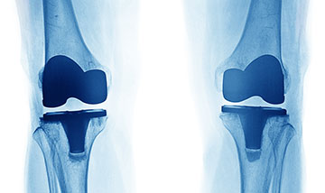 Knee joint replacements